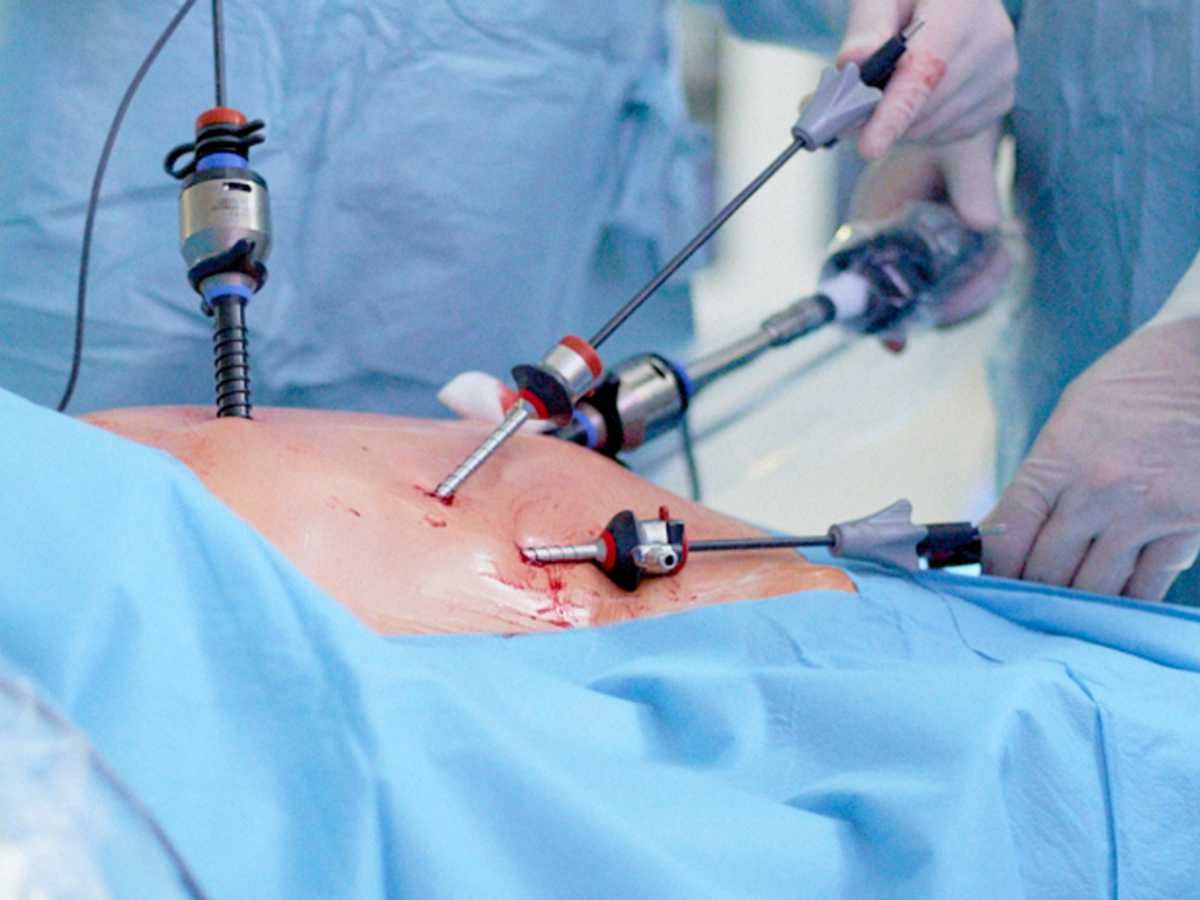 Przepuklina pachwinowa LAPAROSKOPOWO