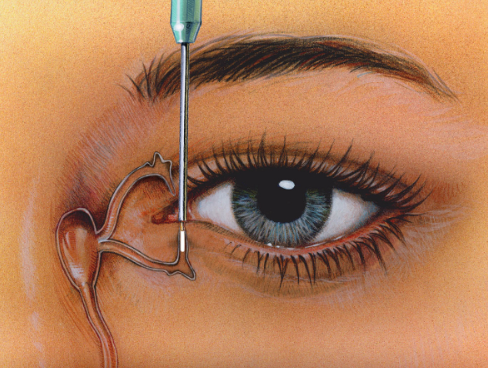 Zatyczki punktów łzowych w zespole suchego oka